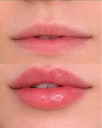 Lip Filler Russian Lips London | Precision Sculpted Lip Enhancement